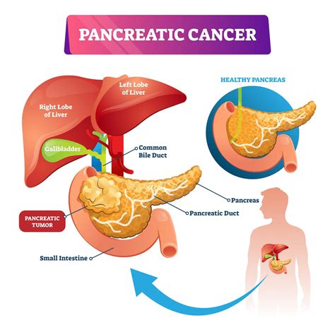 pancreatic cancer org.